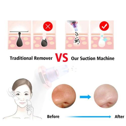 Blackhead Removal Suction Tool